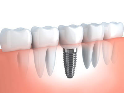 dental implants in Vaughan