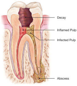 Root canal treatments in Vaughan
